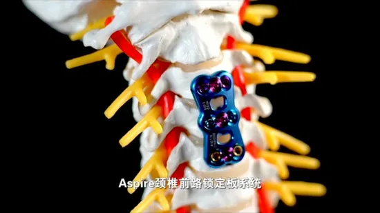 Fixação Cervical do Implante da Coluna da Placa Cervical Anterior